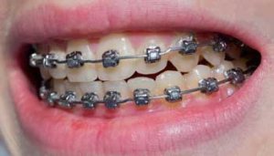 Braces Have Changed, From Metal to Tooth-Colored to Clear