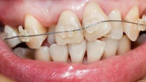 Braces Have Changed, From Metal to Tooth-Colored to Clear